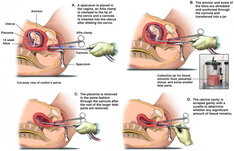 Abortion Suction